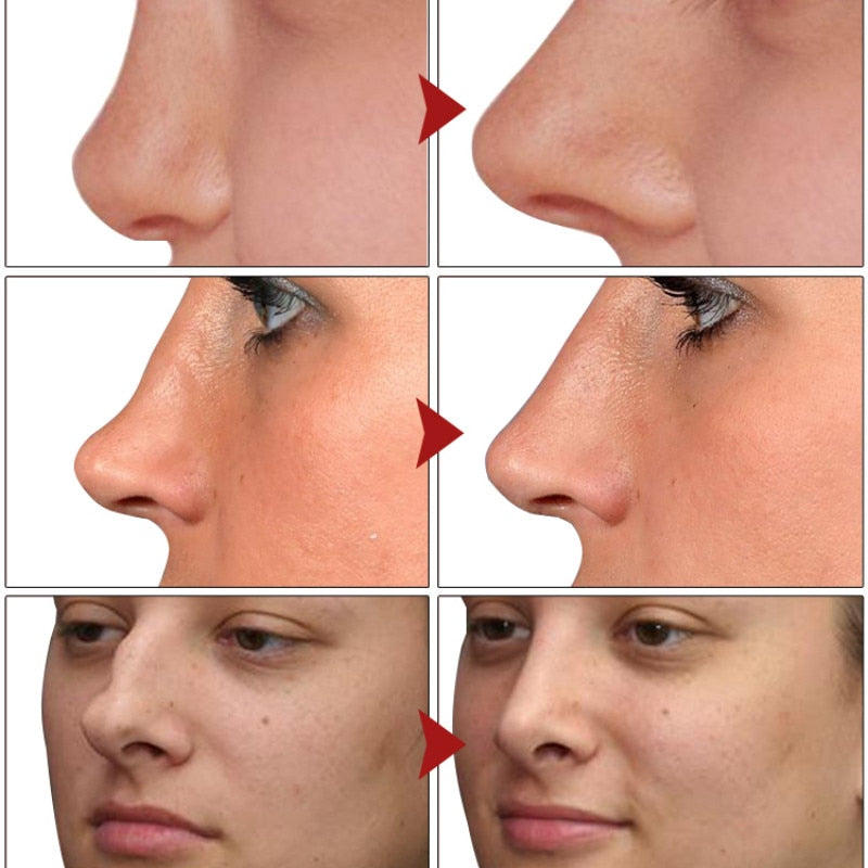 Upper Nose High Rhinoplasty Oil 10ml Nose Rhinoplasty Nose Bone Reshaping Pure Natural Care Skinny Small Nose